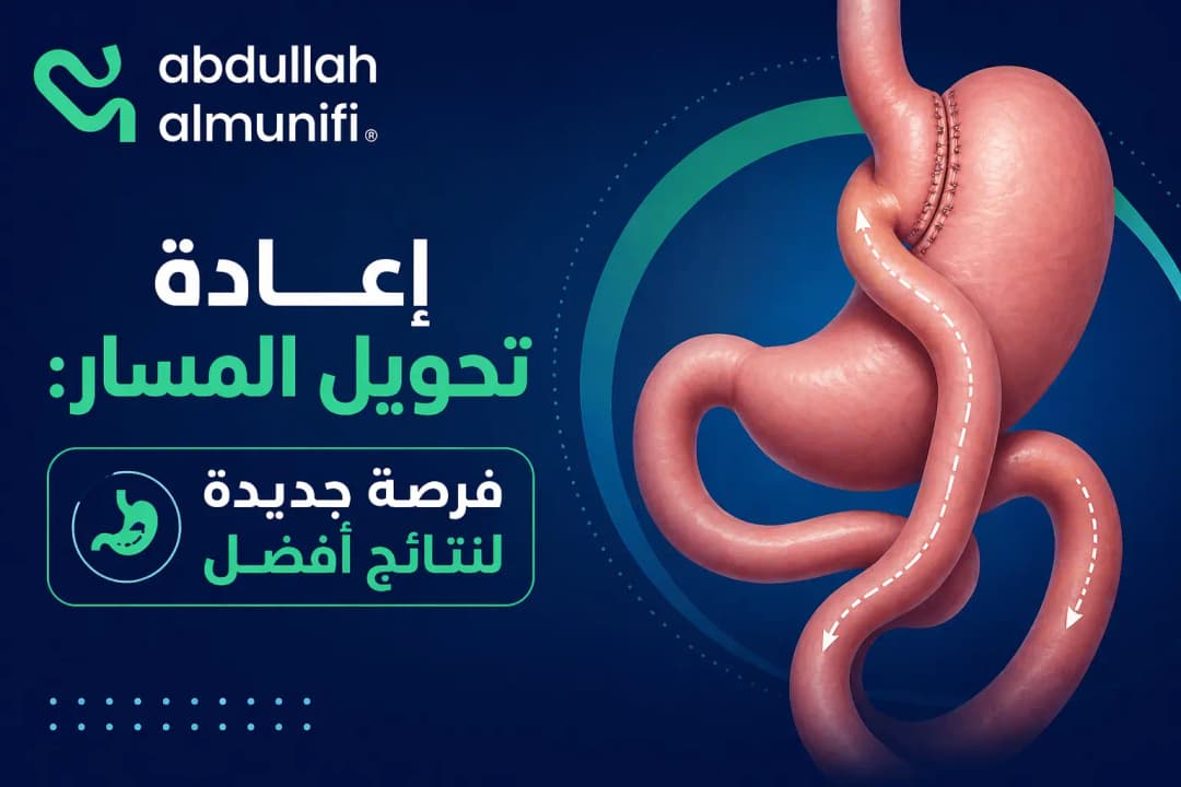 إعادة عملية تحويل مسار المعدة باستخدام تقنيات المناظير المتقدمة لإنقاص الوزن